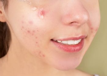 Cara menghilangkan jerawat pasir dengan cepat dalam 1 hari, boleh dicoba