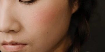 Mitos dan fakta seputar jerawat di wajah yang harus Anda tahu - Jerawat hanya terjadi saat remaja