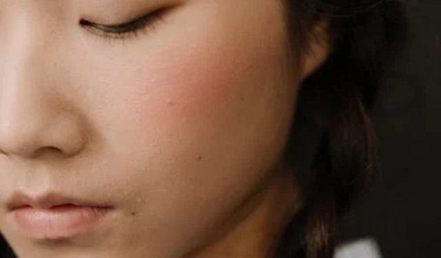 Mitos dan fakta seputar jerawat di wajah yang harus Anda tahu - Jerawat hanya terjadi saat remaja